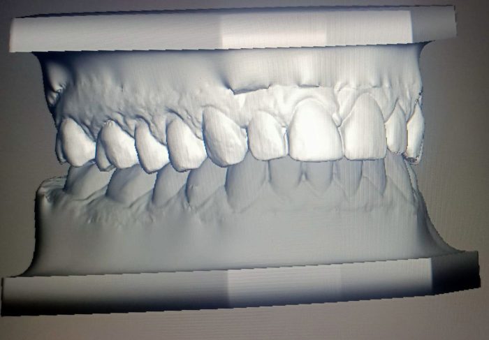 Modello dentale realizzato con stampa 3D